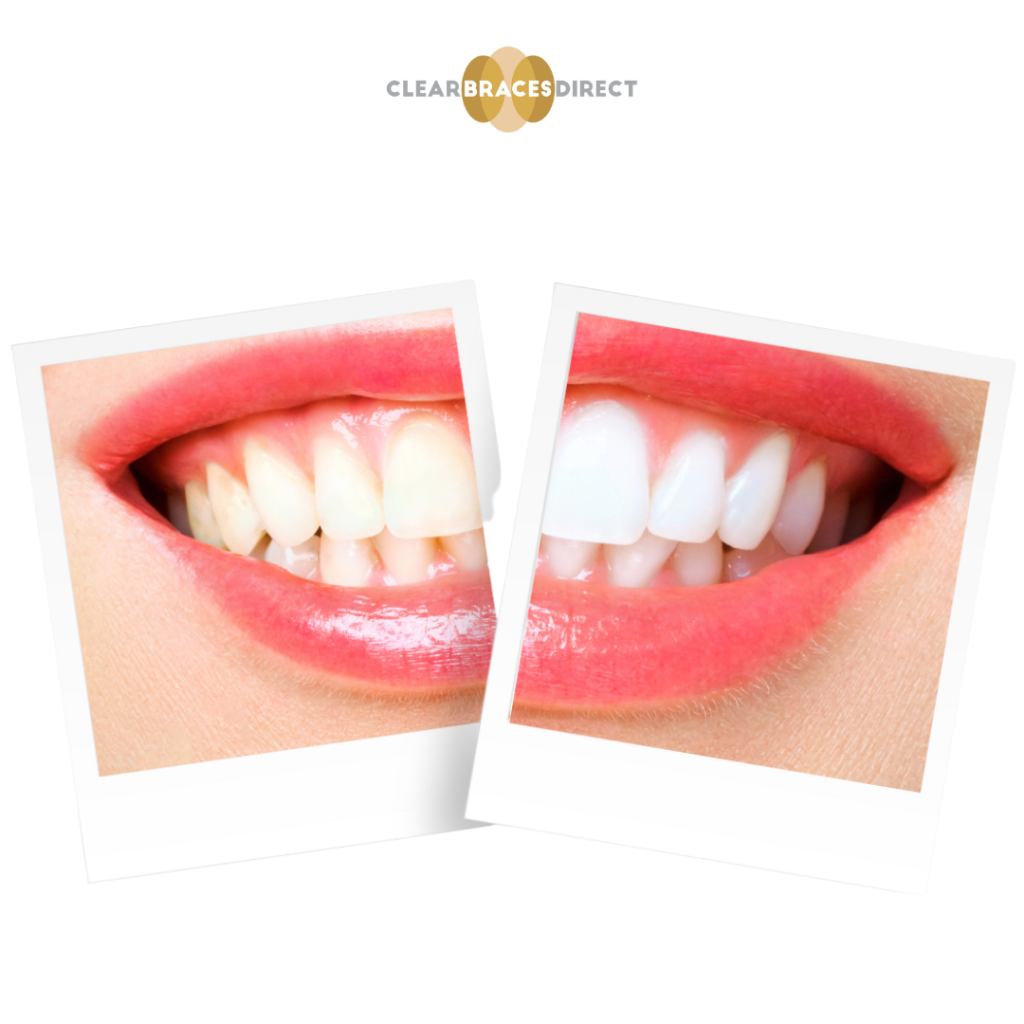 Teeth Whitening at Home Dental Shop Clear Braces Direct